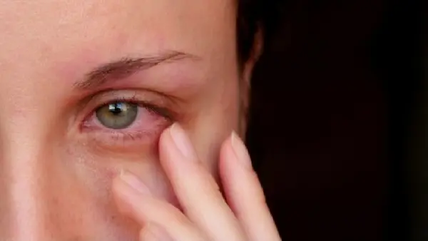 Can Fog Machines Make You Sick-Eye Irritation